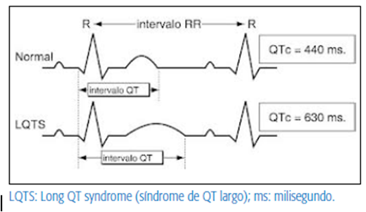 ECG